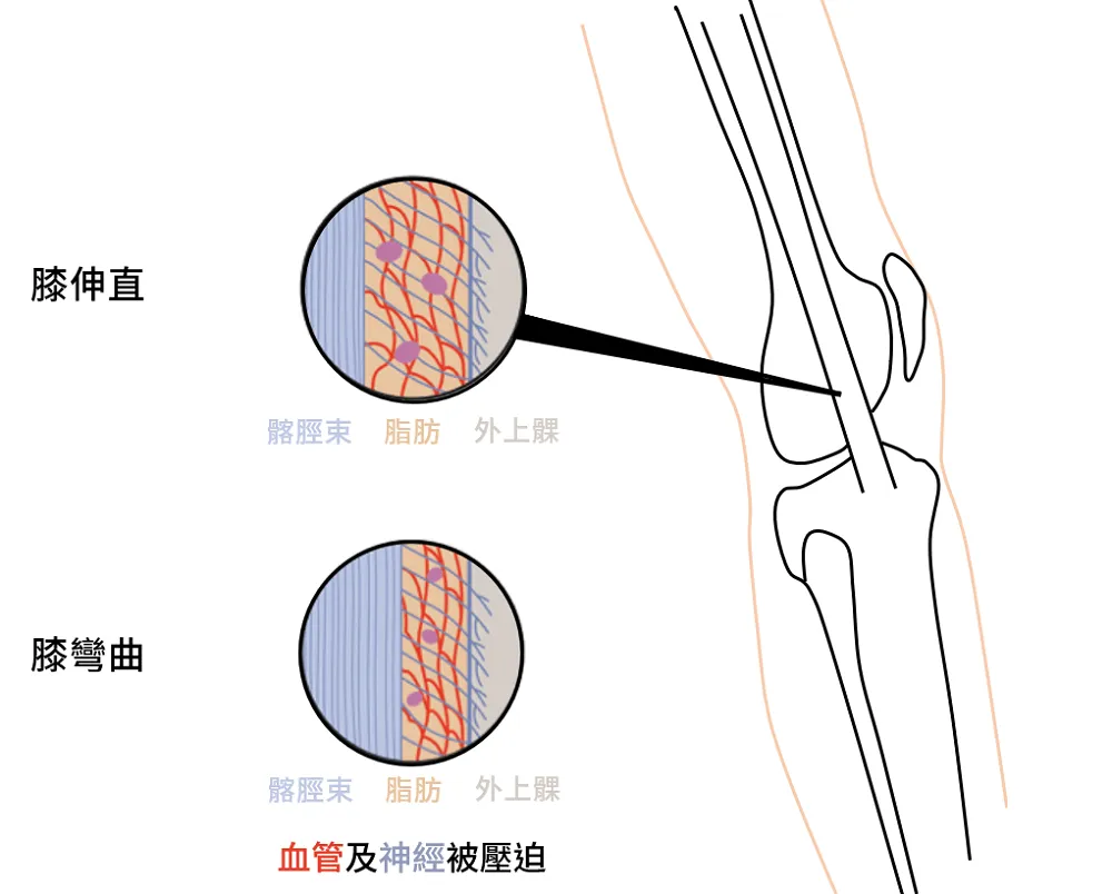 髂脛束張力上升會壓迫到血管及神經受器，產生疼痛
