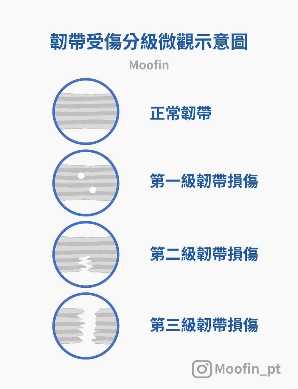 韌帶受傷分級微觀示意圖