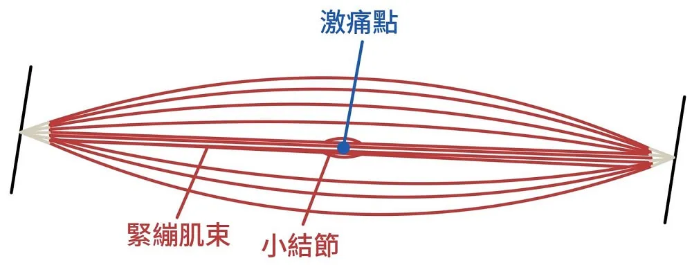 梭形肌肉線圖，中間標出藍點代表激痛點，下方文字分別指向緊繃肌束與那顆小結節