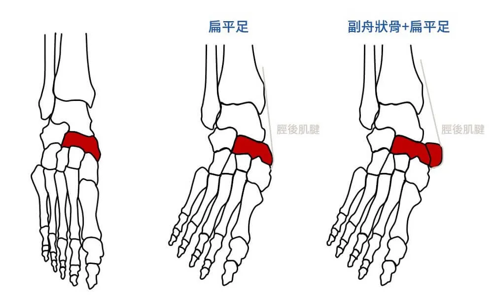 副舟狀骨加上扁平足，會使肌腱及骨頭受更大的壓力