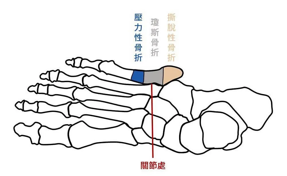以第四及第五蹠骨關節處做為分界，定位傷處