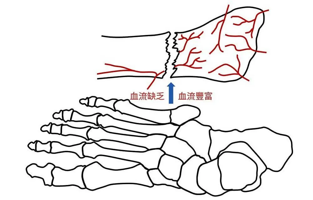 壓力性骨折及瓊斯骨折處都屬血流供應缺乏的區域，不利於復原