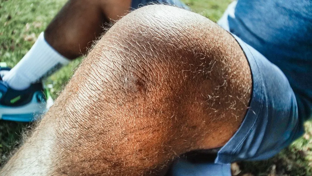 任何膝蓋急性受傷都會伴隨腫脹，需要盡快處理