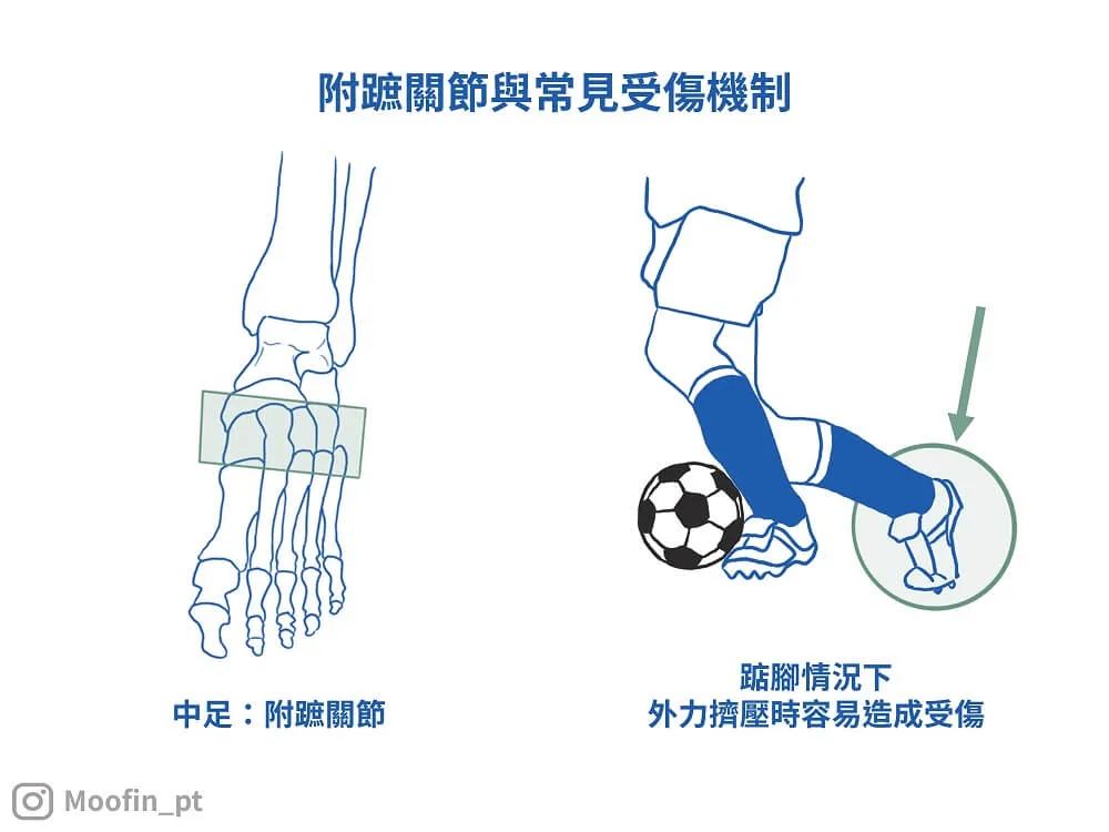 踮腳時受到外力擠壓或是扭轉是受傷常見原因
