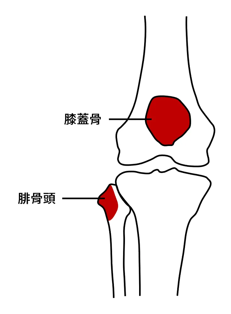壓膝蓋骨及腓骨頭會痛,即需要去照X光
