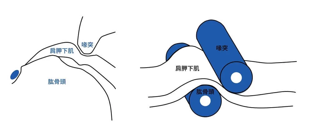 Roller-wringer effect 對照線稿，左圖標出喙突、肱骨頭與夾在中間的肩胛下肌，右圖把兩塊骨頭畫成藍色滾筒絞壓肌腱