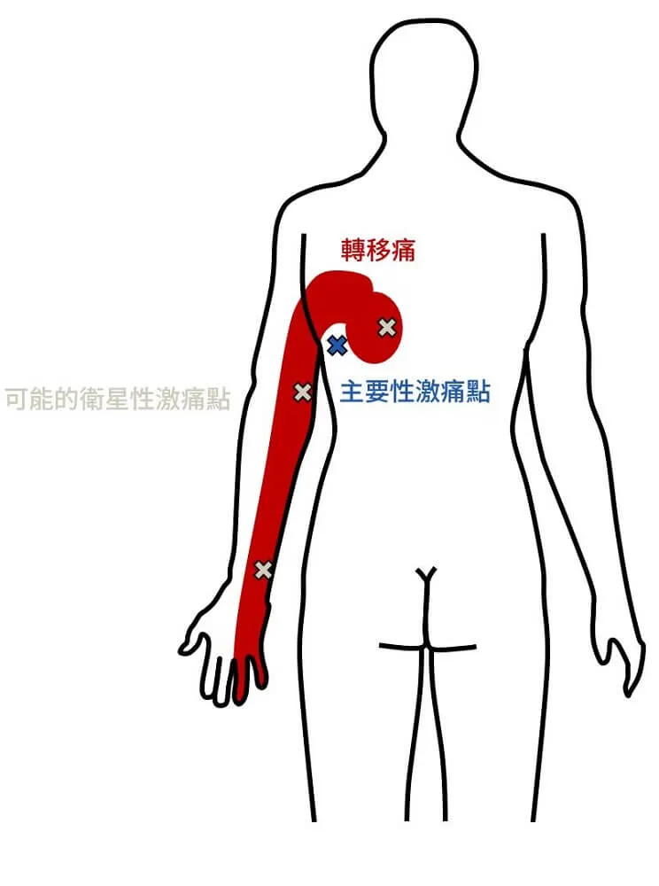 以闊背肌為主要激痛點，其轉移痛區域可能造成三處衛星激痛點