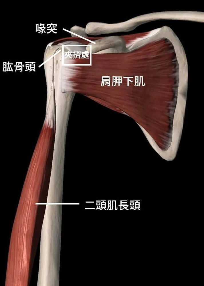 肩關節前側 3D 解剖圖，標示喙突、肱骨頭、肩胛下肌與二頭肌長頭，白框圈出喙突與肱骨頭之間的夾擠處