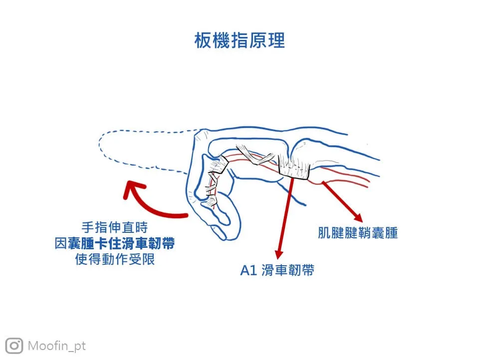 腱鞘若是因為受傷腫大，在手指活動時就會容易有卡頓感